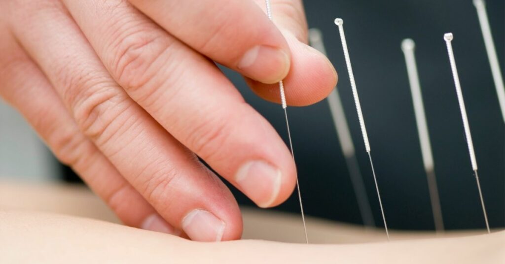 An acupuncture practitioner treating a patient.